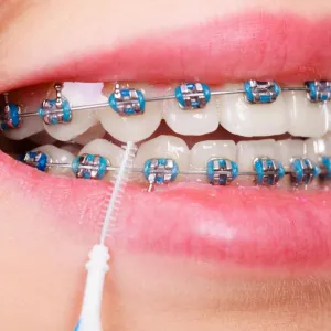 Aparelho dentário