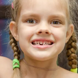 Dente caíndo