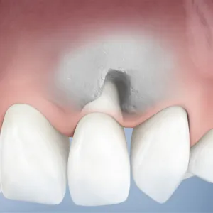 Dente canino