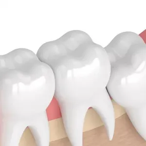 Dente de siso
