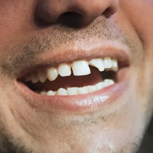 Dente quebrado