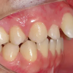 Dente torto