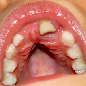 Dentes arrancados