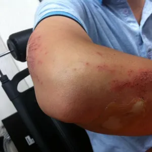 Hematoma