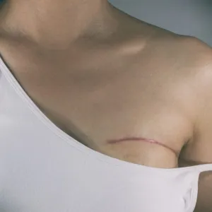 Mastectomia