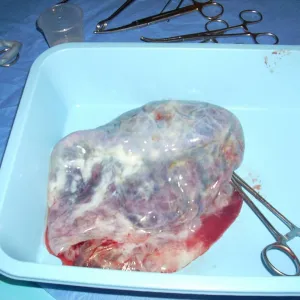 Placenta