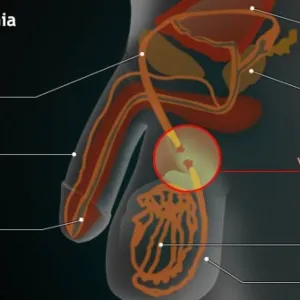 Vasectomia